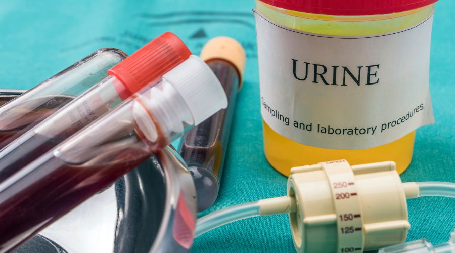 Comprendre les tests et analyses d'urine